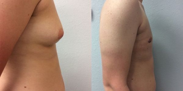 Male Breast Reduction Before and After Patient 92 5