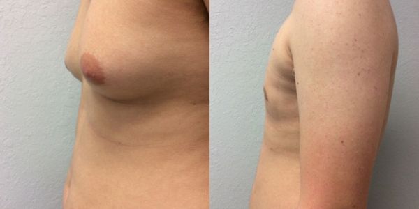 Male Breast Reduction Before and After Patient 92 4