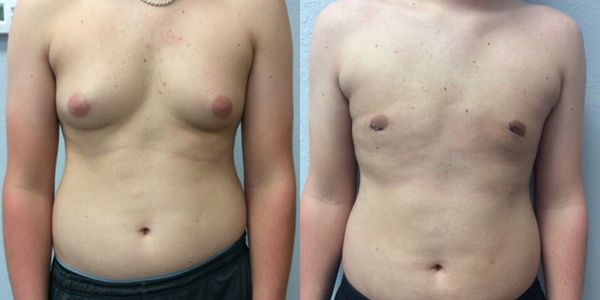 Male Breast Reduction Before and After Patient 92 3