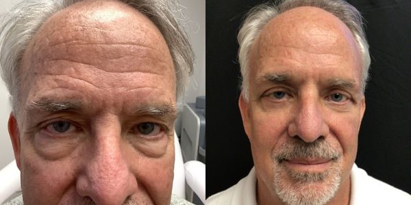 Male Eyelid Surgery Before and After Patient 155