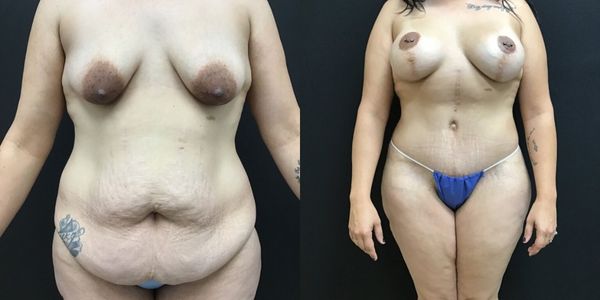 Mommy Makeover Before and After Patient 163