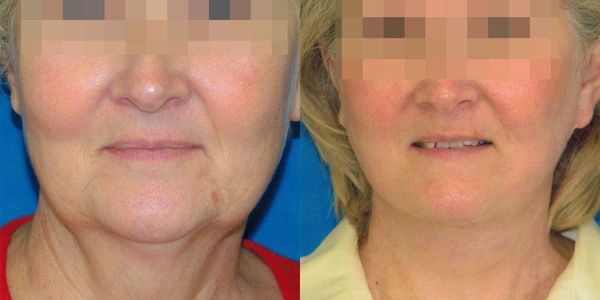 Lower Facelift Before And After Patient 10 3