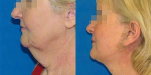 Lower Facelift Before And After Patient 10 2