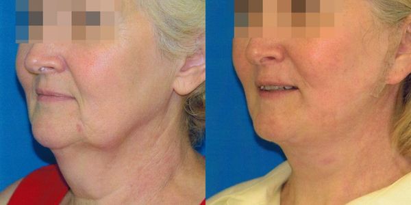 Lower Facelift Before And After Patient 10