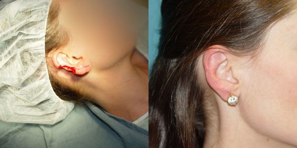 Otoplasty Before And After Patient 95