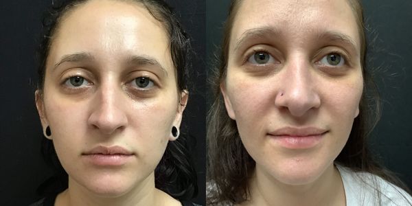 Rhinoplasty Before And After Patient 186 3
