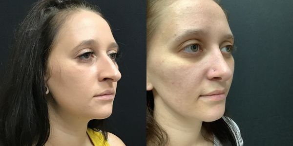Rhinoplasty Before And After Patient 186 2
