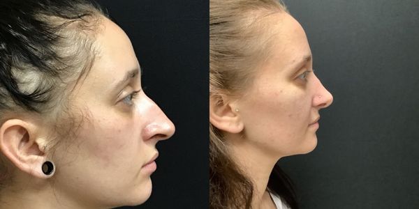 Rhinoplasty Before And After Patient 186