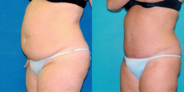 Tummy Tuck Before and After Patient 111 2