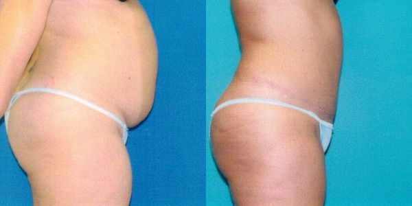 Tummy Tuck Before and After Patient 111