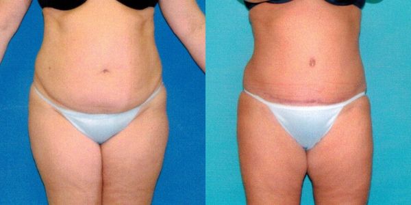 Tummy Tuck Before and After Patient 111 3