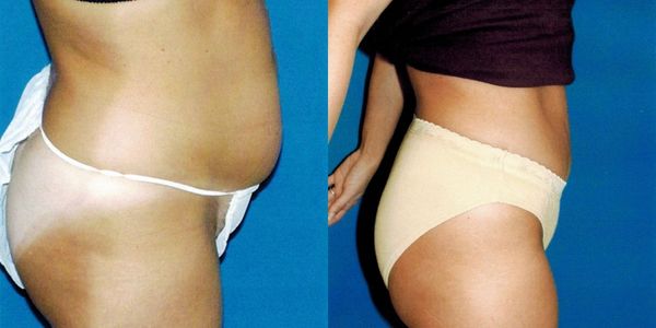 Tummy Tuck Before and After Patient 113 4