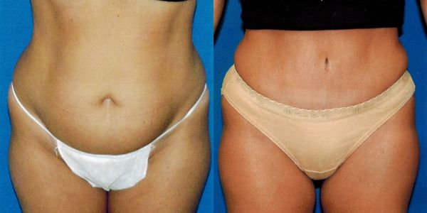 Tummy Tuck Before and After Patient 113 2