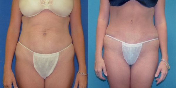 Tummy Tuck Before and After Patient 114 3