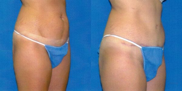 Tummy Tuck Before and After Patient 116 2