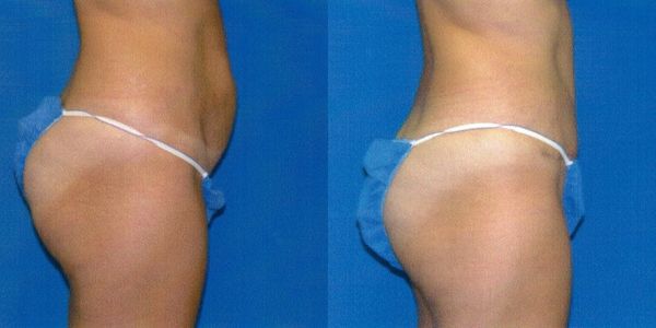 Tummy Tuck Before and After Patient 116