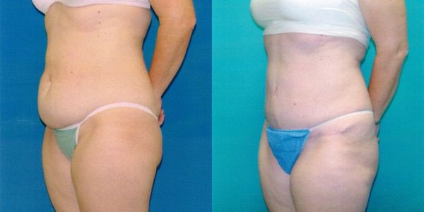 Tummy Tuck Before and After Patient 117