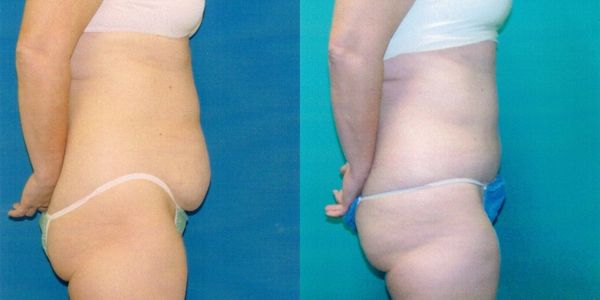 Tummy Tuck Before and After Patient 117 2