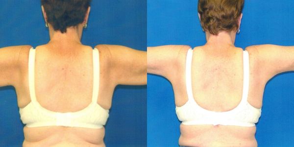 Arm Lift Before and After Patient 118 4