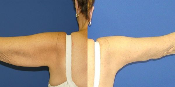 Arm Lift Before and After Patient 118 3