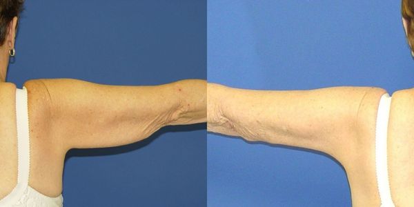 Arm Lift Before and After Patient 118 2