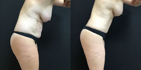 Tummy Tuck Before and After Patient 142
