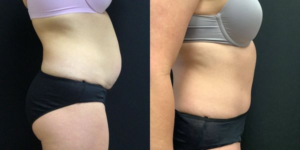 Tummy Tuck Before and After Patient 160