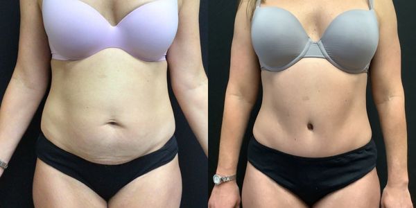 Tummy Tuck Before and After Patient 160 2