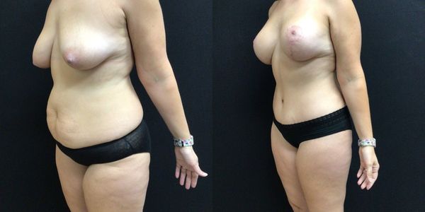 Tummy Tuck Before and After Patient 162 5