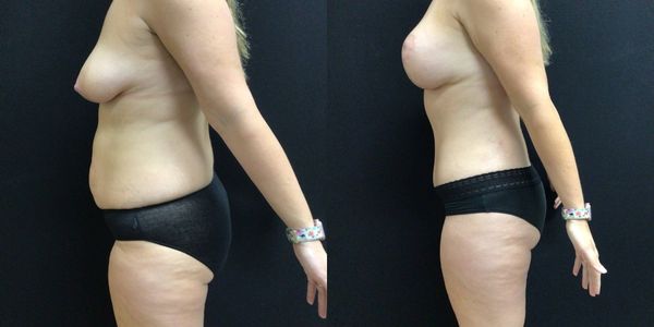 Tummy Tuck Before and After Patient 162 6