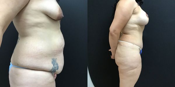 Tummy Tuck Before and After Patient 163 2