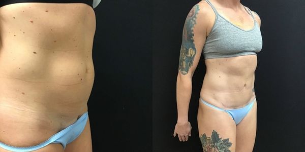 Tummy Tuck Before and After Patient 172 2