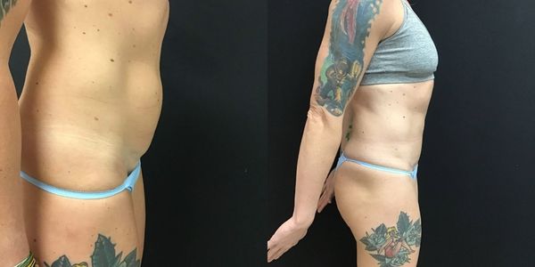 Tummy Tuck Before and After Patient 172