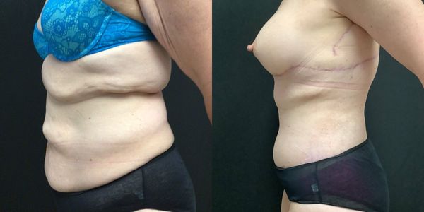 Tummy Tuck Before and After Patient 180 3