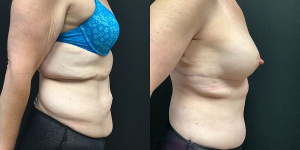 Tummy Tuck Before and After Patient 180