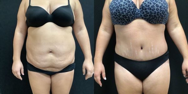Tummy Tuck Before and After Patient 182 3