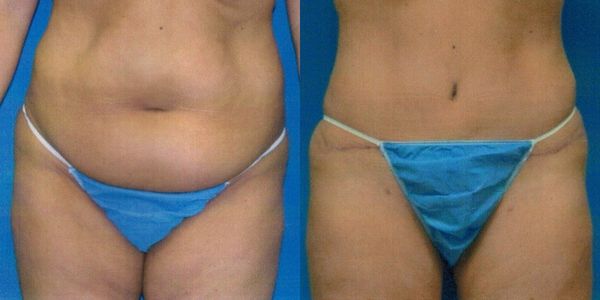 Tummy Tuck Before and After Patient 24