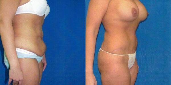 Tummy Tuck Before and After Patient 25