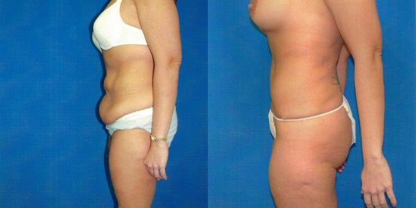 Tummy Tuck Before and After Patient 25 2