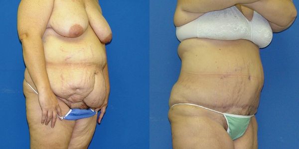 Tummy Tuck Before and After Patient 28