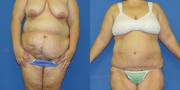 Tummy Tuck Before and After Patient 28 2