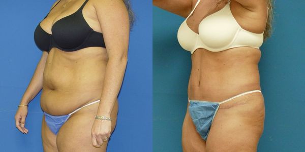 Tummy Tuck Before and After Patient 29 4