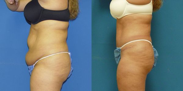Tummy Tuck Before and After Patient 29 3