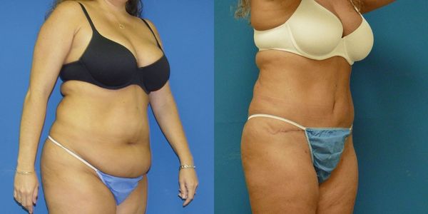 Tummy Tuck Before and After Patient 29 2
