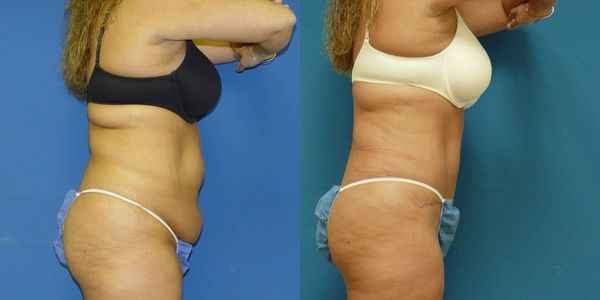Tummy Tuck Before and After Patient 29