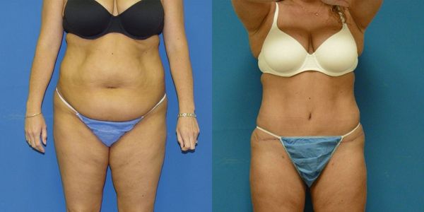 Tummy Tuck Before and After Patient 29 5