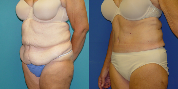 Tummy Tuck Before and After Patient 30 3