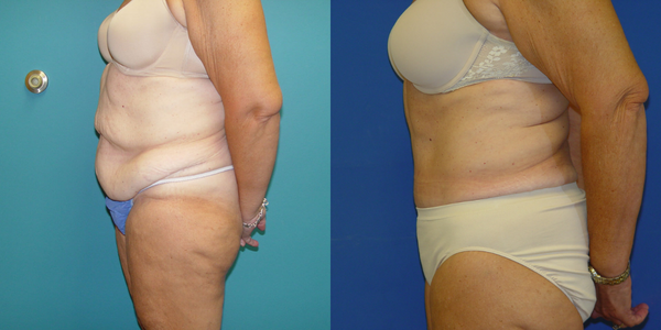Tummy Tuck Before and After Patient 30 2