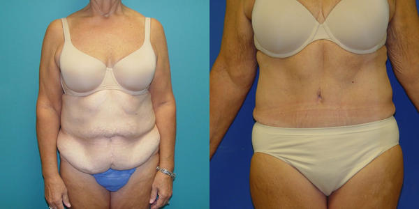 Tummy Tuck Before and After Patient 30 4