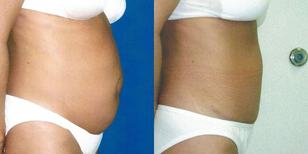 Tummy Tuck Before and After Patient 32